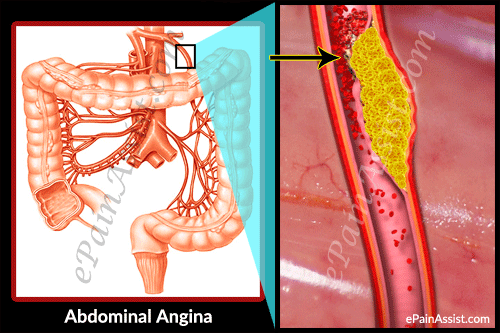 abdominal angina