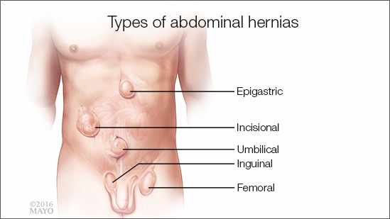 abdominal hernia