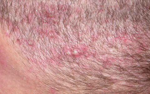 acne varioliformis
