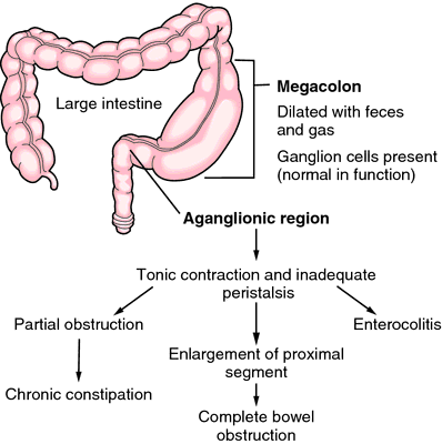 aganglionosis