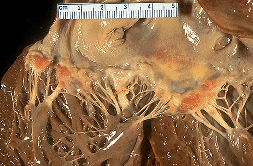 atypical verrucous endocarditis