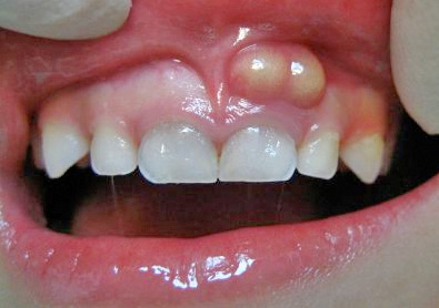 dental abscess