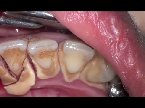 dental calculus