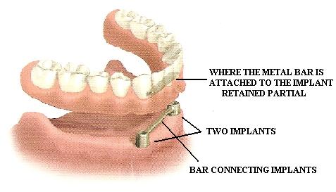 dental plate