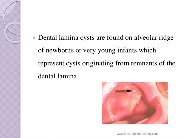 dentinal lamina cyst