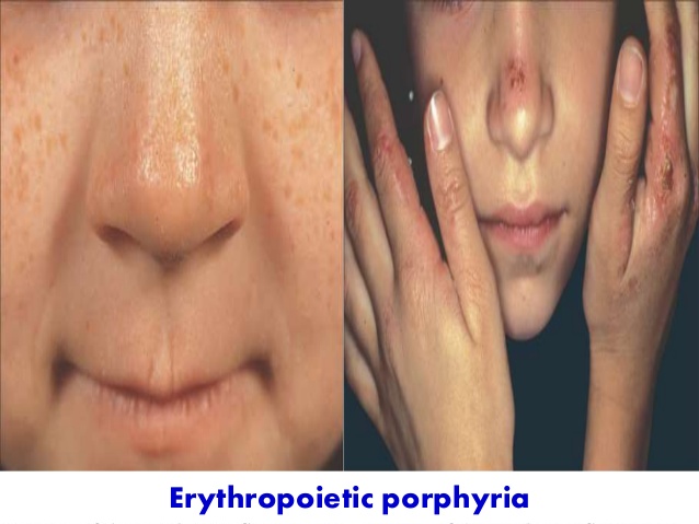 erythropoietic porphyria