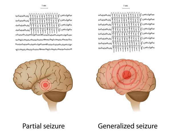focal epilepsy
