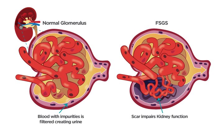 focal segmental glomerulosclerosis
