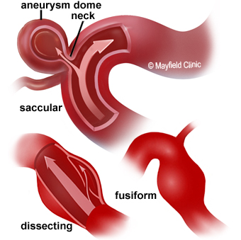 fusiform aneurysm