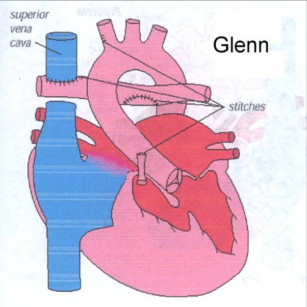 glenn’s operation