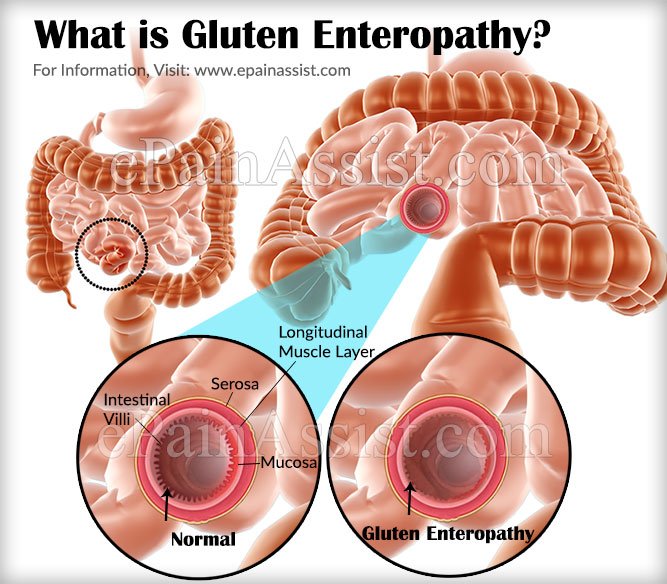 gluten enteropathy
