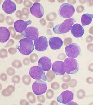 leukemic reticuloendotheliosis