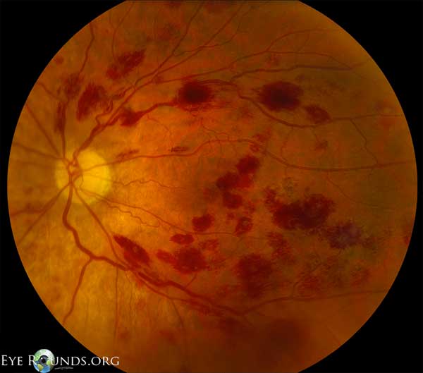 leukemic retinopathy