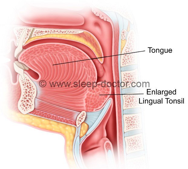 lingual tonsil