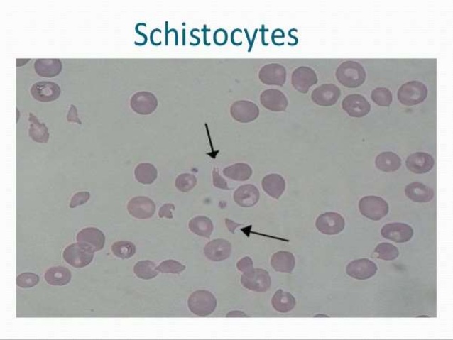 microangiopathic hemolytic anemia