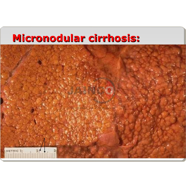 micronodular