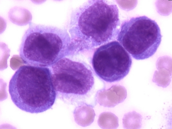 monocytic leukemia
