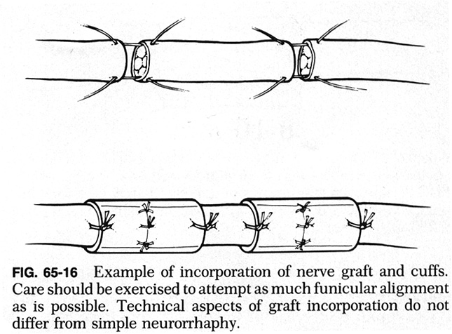nerve graft