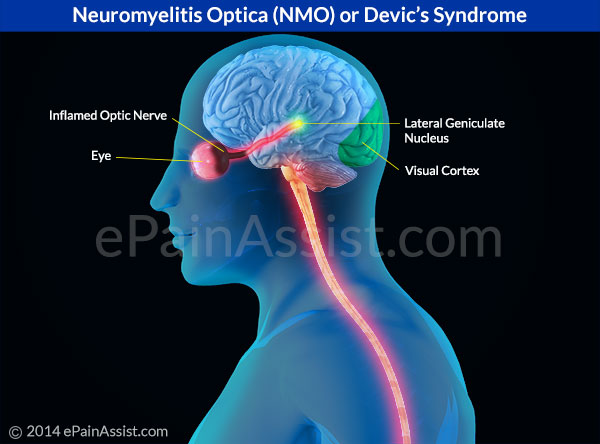neuromyelitis optica