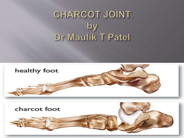 neuropathic joint