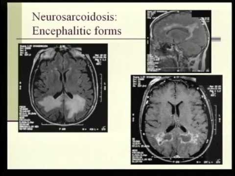 neurosarcocleisis