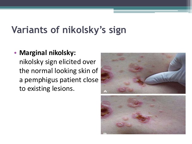 Nikolsky’s sign