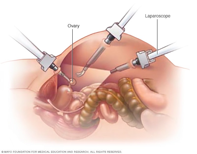 oophorectomy