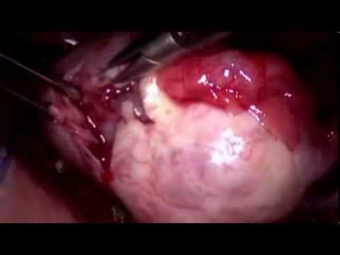 oophorocystectomy