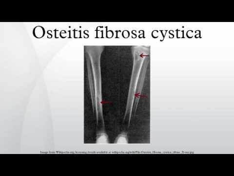 osteitis fibrosa cystica
