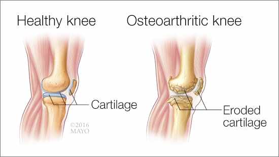 osteoarthroses