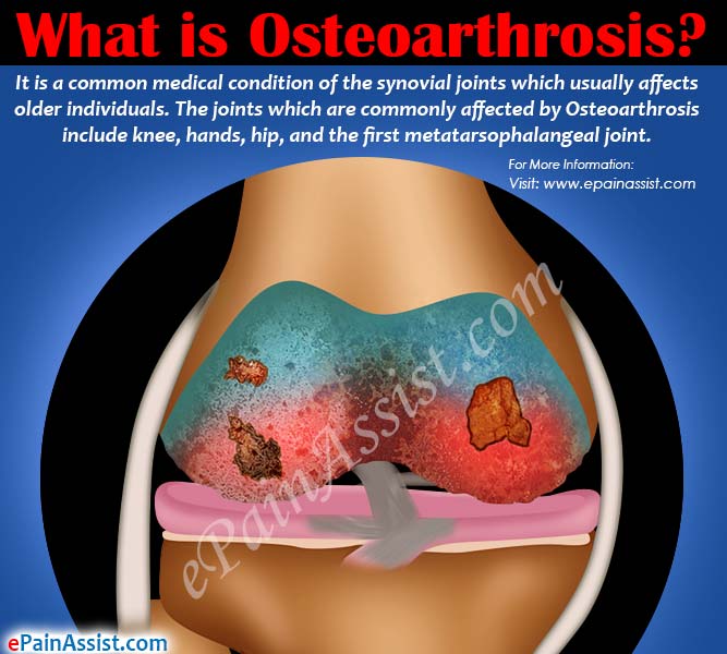 osteoarthrosis