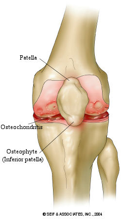 osteochondritis
