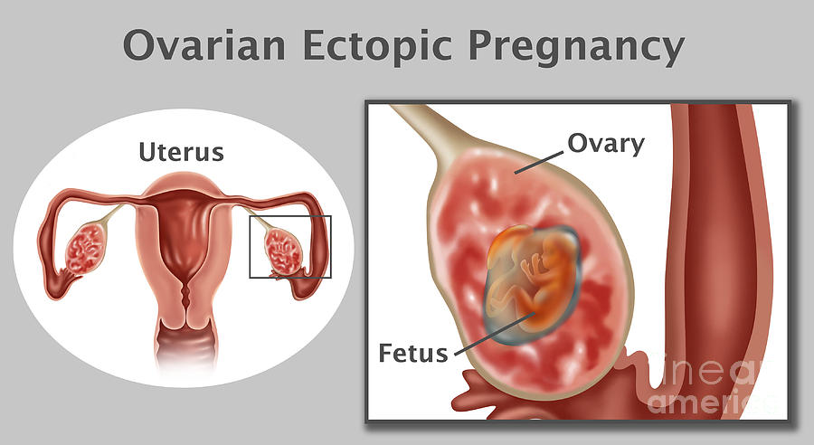 ovarian pregnancy