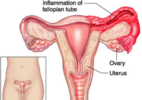 ovariosalpingitis