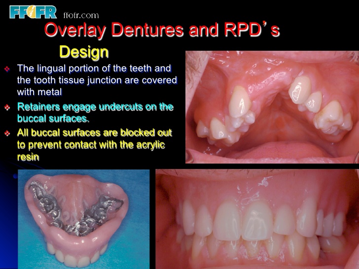 overlay denture