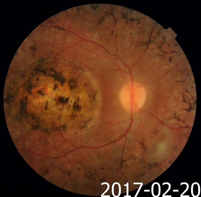 pigmentary retinopathy