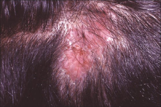 pilar tumor of scalp