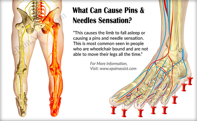 pins and needles