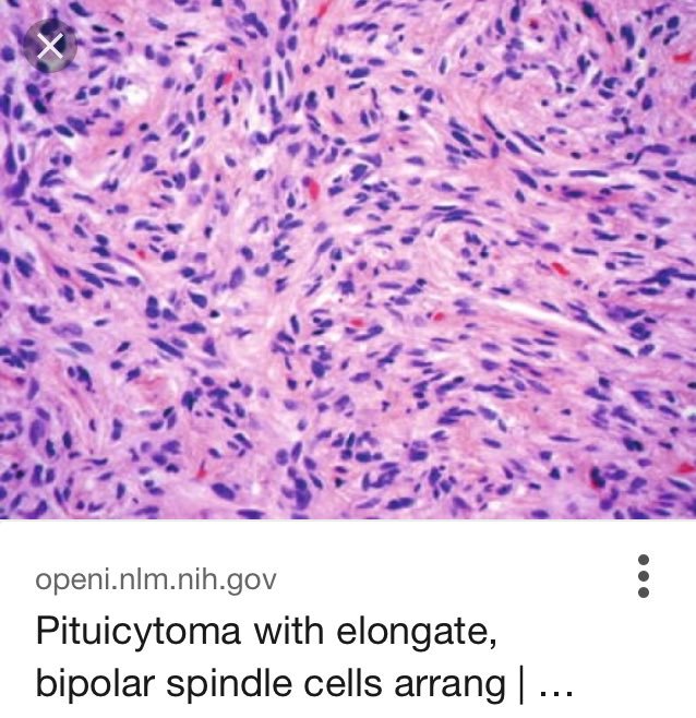 pituicytoma