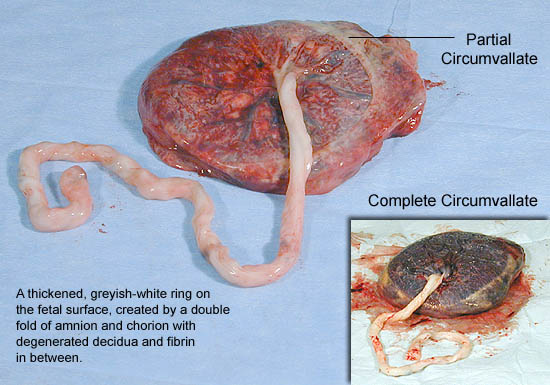 placenta circumvallata