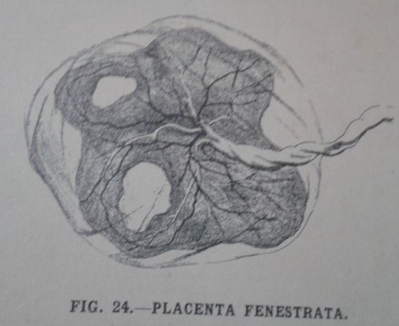 placenta fenestrata