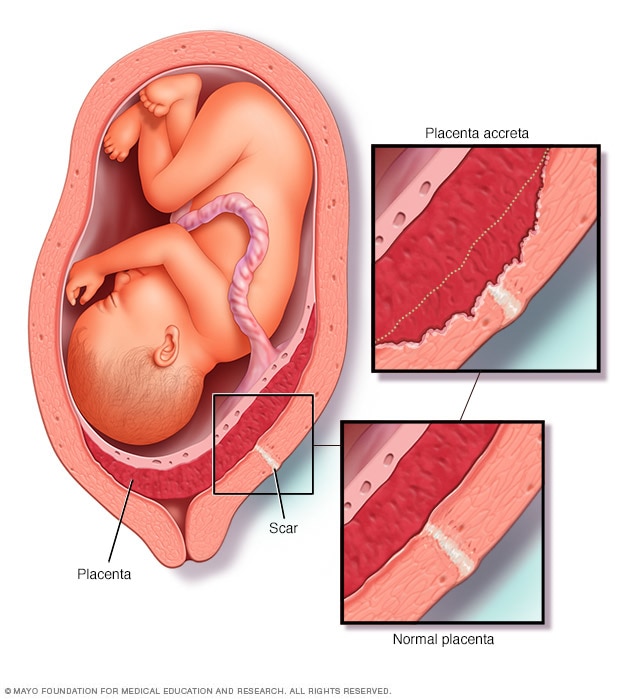 placenta increta