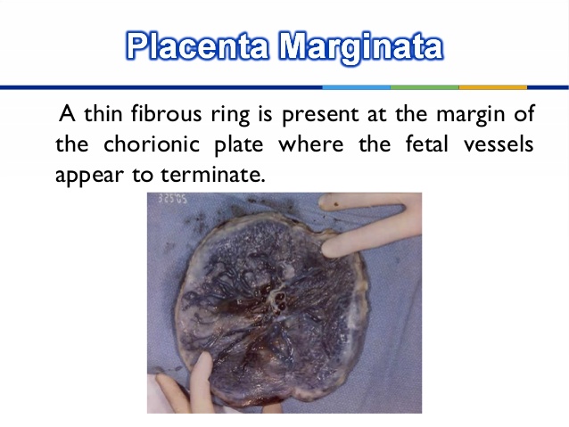 placenta marginata