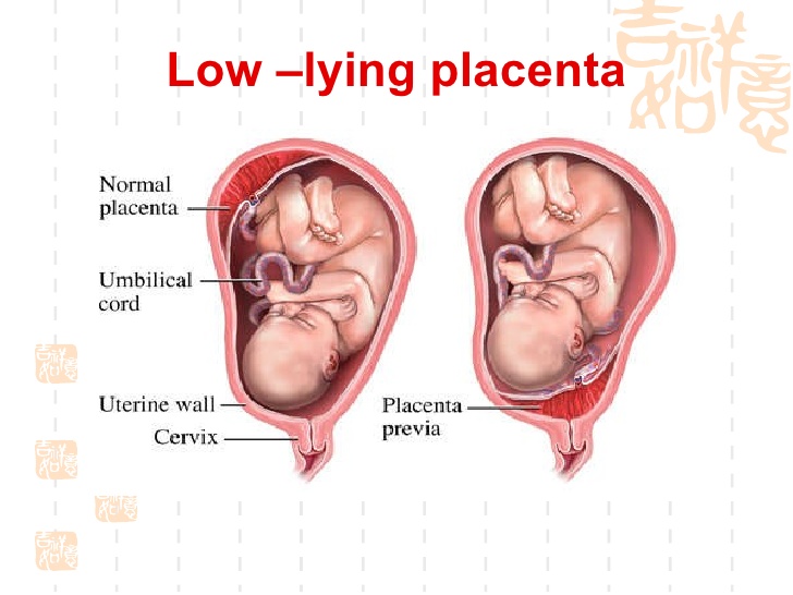 placental dystocia