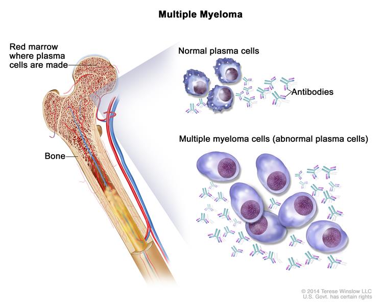 plasma cell myeloma