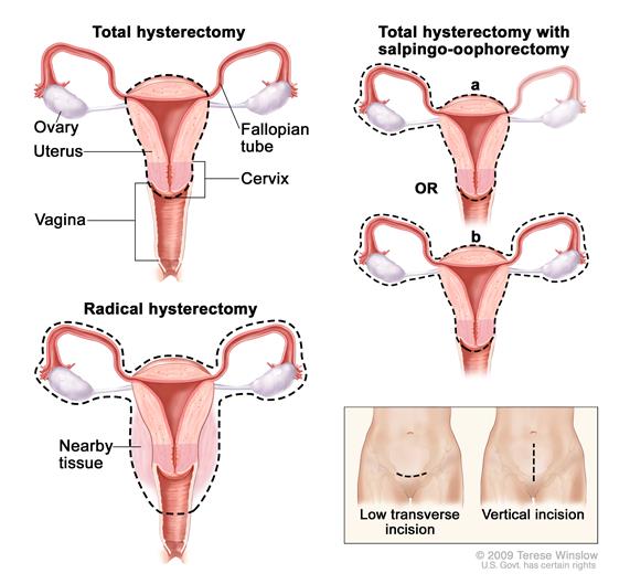 radical hysterectomy
