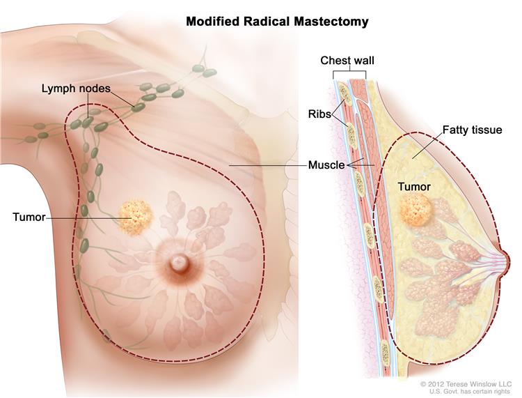 radical mastectomy