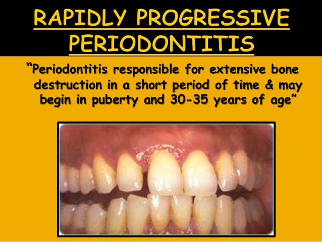 rapidly advancing juvenile periodontitis