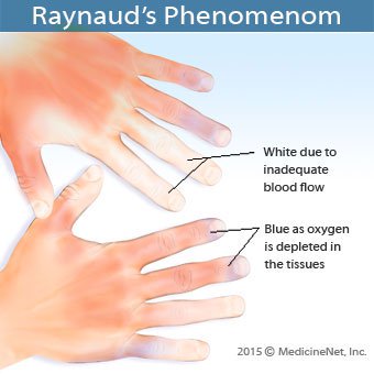 raynaud's phenomenon