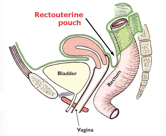 rectouterine